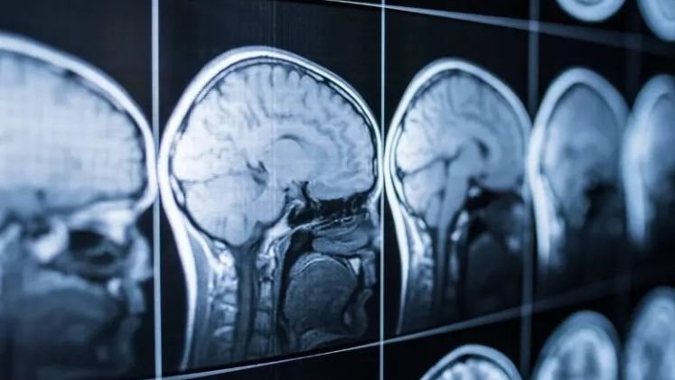 Desarrollan IA para detectar Alzheimer temprano mediante el sueño